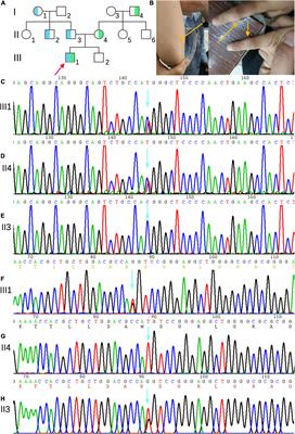 Clinical and Genetic Analysis of a Family With Sitosterolemia Caused by a Novel ATP-Binding Cassette Subfamily G Member 5 Compound Heterozygous Mutation